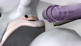 3D动画演示修复髋臼盂唇手术的全过程，非常直观
