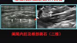 急性阑尾炎的超声诊断 王光霞