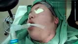实拍脸部抽脂整形美容手术