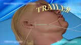 3D动画演示线雕脸部提升手术，光看着都觉得好疼！