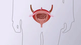 【医学动画】带你了解什么是膀胱癌？