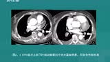 ICU患者床边胸片评价---贺文 - 腾讯视频