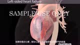 医生必备3D演示动画系列（36）：为什么会心衰