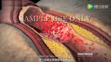 3D医学动画《什么是高血压》_腾讯视频