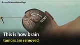 医学3D动画演示：如何摘除大脑中的肿瘤