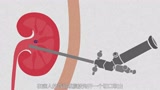 肾结石的形成、治疗和预防（中文解说）