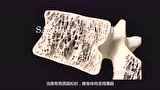 医生必备3D演示动画系列（20）：椎体成形术与后凸成形术