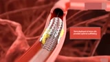 医学3D动画演示：心脏冠状动脉支架放置过程