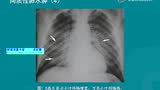 ICU患者床边胸片诊断概述 贺文 - 腾讯视频