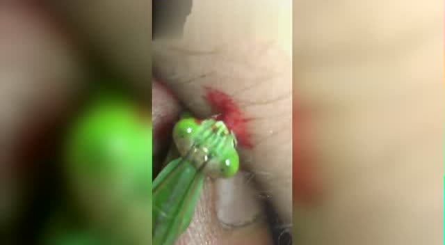 身上长了猴子怎么办?