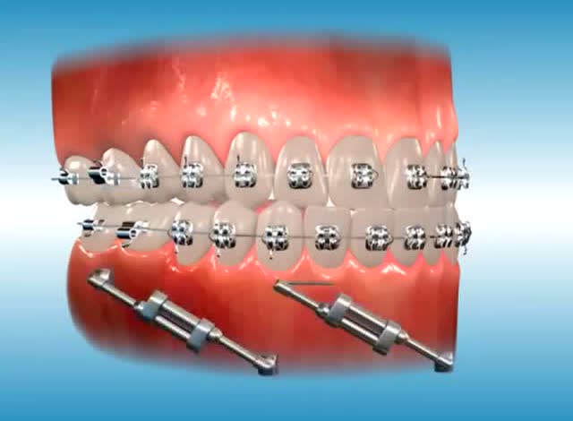 正畸托槽粘接过程超清示例