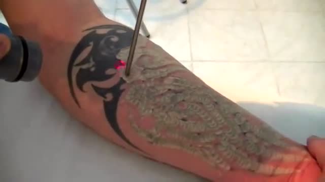 激光去除文身 腾讯网
